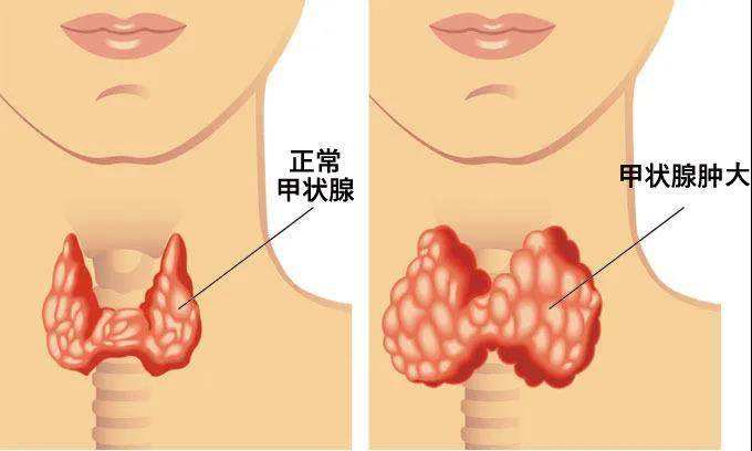 141723602311842992.jpeg 甲狀腺腫.jpeg